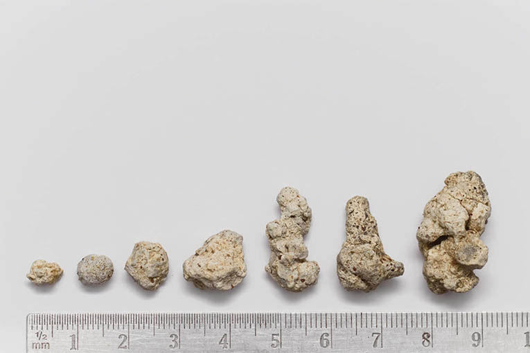 Verschiedene Formen von Harnsteinen