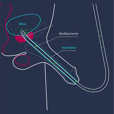 Intravesikale Therapie Grafik