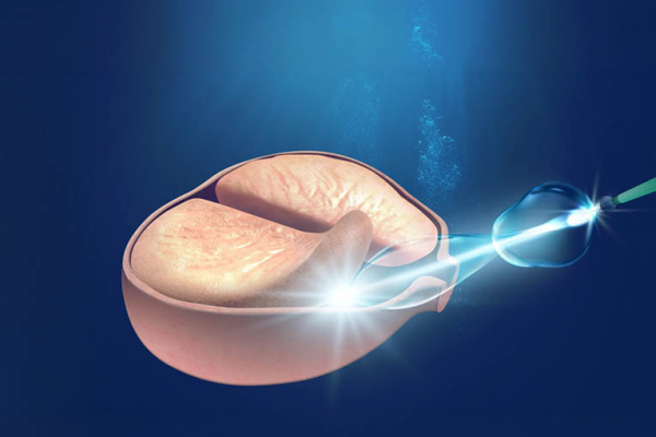 BPH Grafik - Boston Scientific