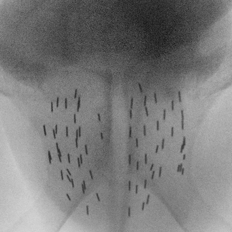 Brachytherapie Seeds