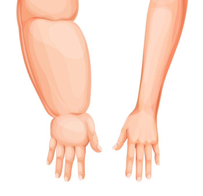 Gegenüberstellung von Unterarmen und Händen, eine Seite mit Lymphödem ist deutlich angeschwollen im Vergleich zur anderen Seite