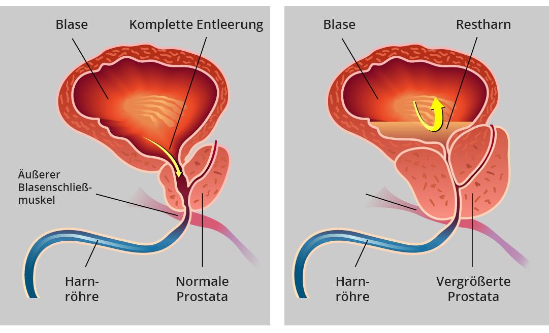 Prostata auf deutsch