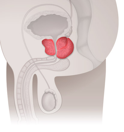 Prostata-Arterien Embolisation (PAE)