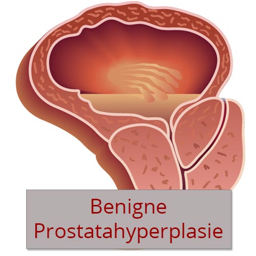 Még ajánljuk - Benigne prostatahyperplasie bph symptome
