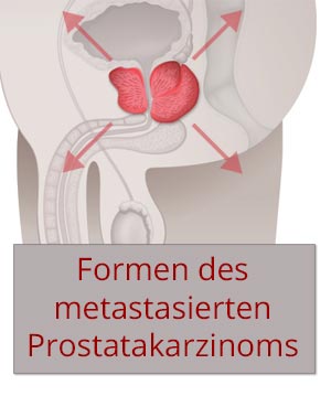 Metastasiertes-PCa-Formen