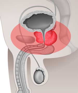Entfernung von Becken-Lymphknoten im Rahmen der radikalen Prostatovesikulektomie 
