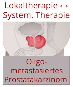 Lokaltherapie in der Behandlung von oligometastasierten und oligoprogredienten Krebserkrankungen