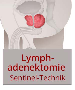 Lymphadenektomie beim lokalisierten Prostatakarzinom: Sentinel-Technik