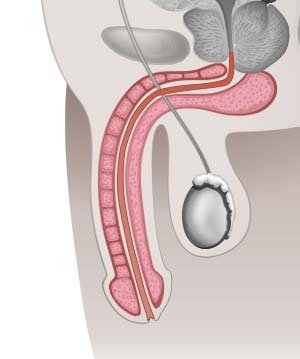 Operative Therapie der Induratio penis plastica: Indikation und Techniken