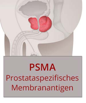 PSMA-Theranostik