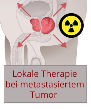 Lokale Therapie bei metastasiertem Tumor – ein Paradigmenwechsel?