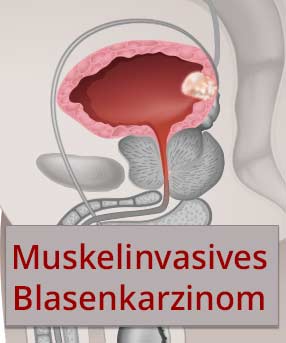 Chemo-, und Immuntherapie bei muskelinvasivem Blasenkarzinom