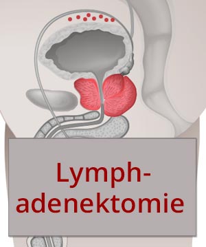 Die Lymphadenektomie beim lokalisierten Prostatakarzinom – pro und kontra
