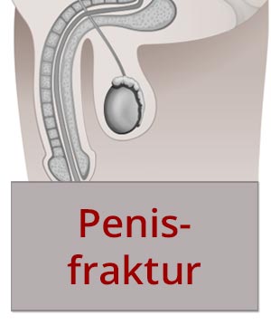 Diagnostik und Therapie der Penisfraktur