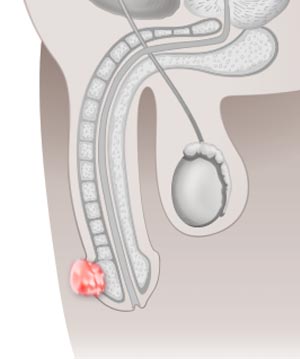 Diagnostik und Therapie des Peniskarzinoms