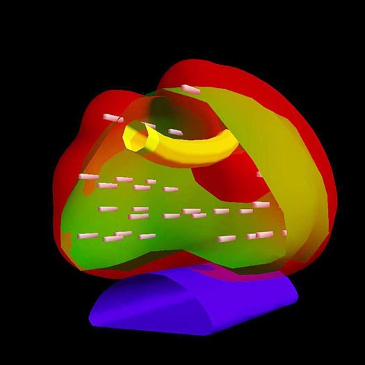 Brachytherapie Seeds 3D Darstellung