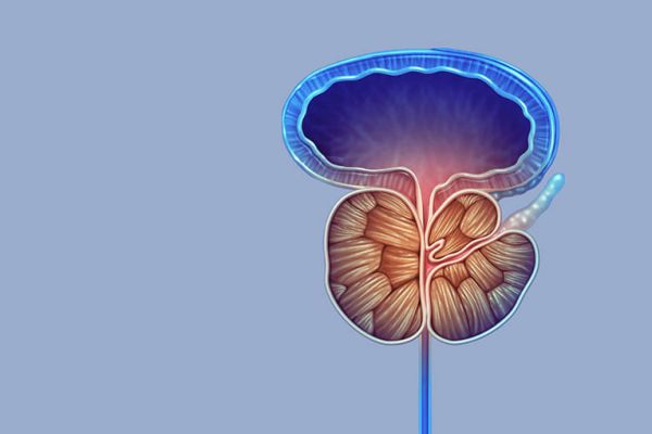 Gutartige Prostatavergrößerung Grafik