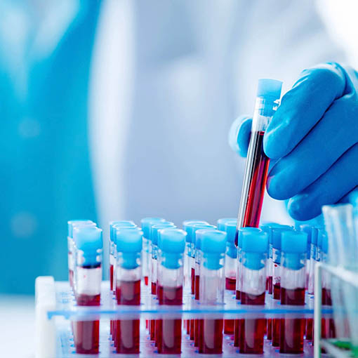 Blutuntersuchung Stockholm3 Test