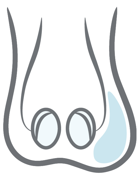 Hydrocele Icon