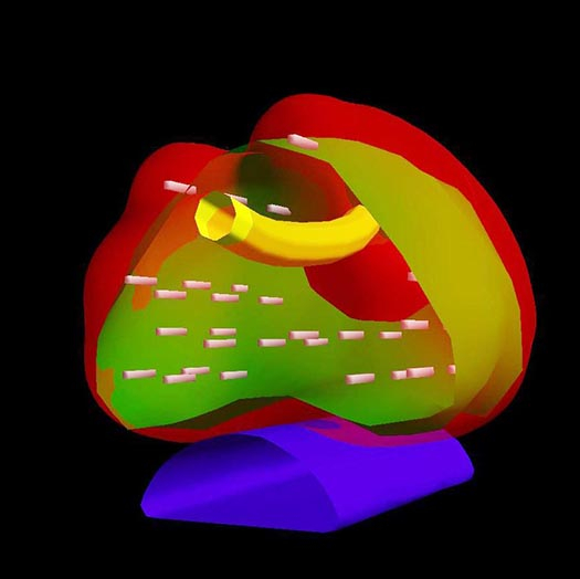 Brachytherapie Seeds 3D Darstellung