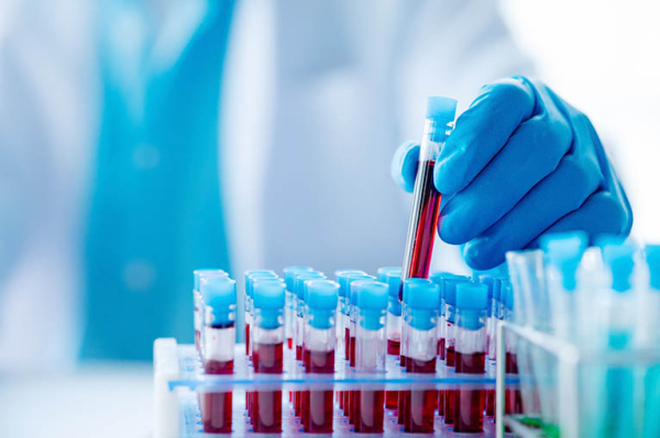 Stockholm3 Test Blutprobe