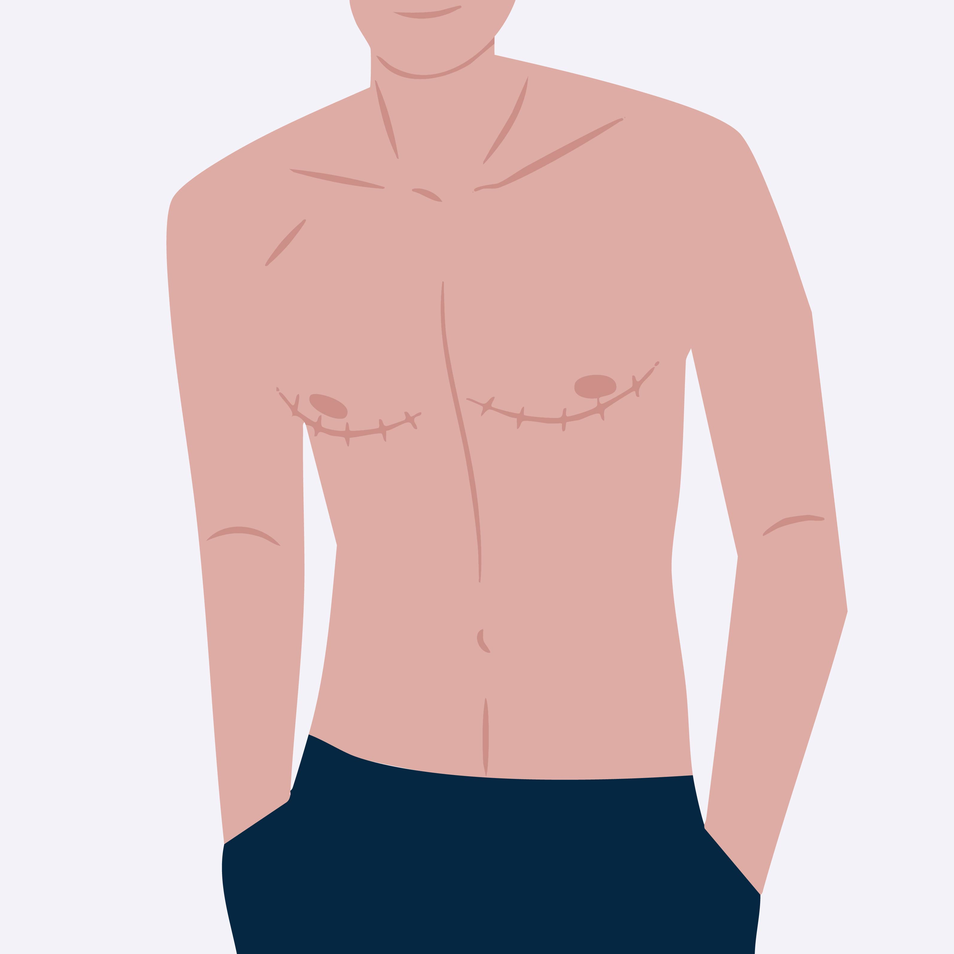 Mastektomie Illustration männlicher Oberkörper